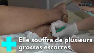 Comment soulager une nécrose