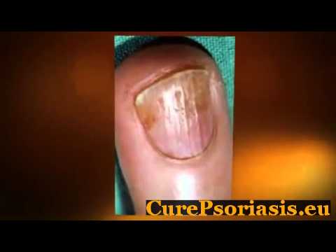 Psoriasis Natural Treatment - Psoriasis And Vitamin B Deficiency