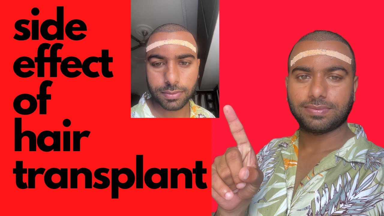 Side Effect Of Hair Transplant ! Hair Transplant Ke side Effect Kiya