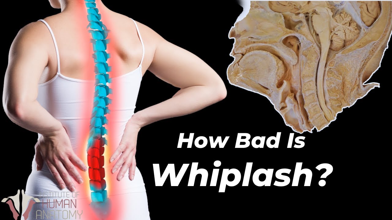 How Whiplash Can Destroy Your Neck... - YouTube