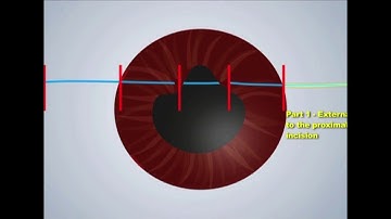 ESCRS Video Of The Month, May 2019: Single pass 4 throw pupilloplasty