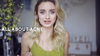 All I Learned About Acne in Paris | Sonya Esman(In January, I partnered with La Roche-Posay to go to Paris to learn everything I can about acne, the causes and more importantly, the solutions. Hopefully this ..., 2016-03-29T13:08:03.000Z)