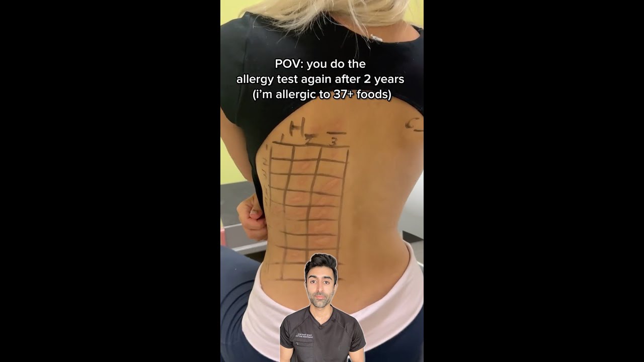 How an Allergy Tests Works