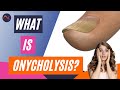 What is Onycholysis? Nail lifting and Separation Explained!
