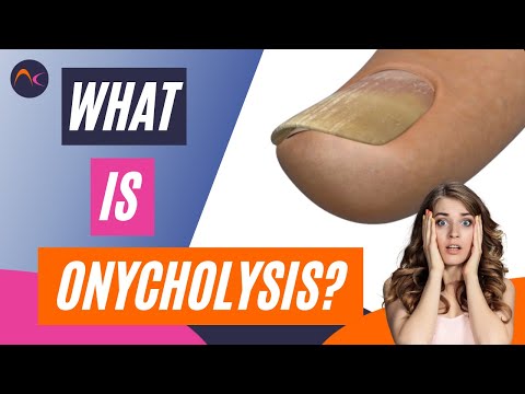 ভিডিও: নখের onychorrhexis কি?