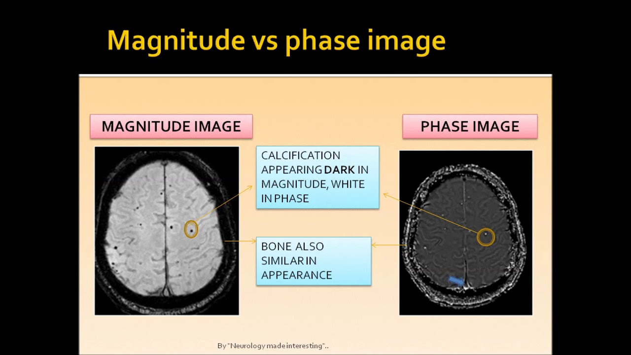 MRI BRAIN (SWI,GRE) - YouTube