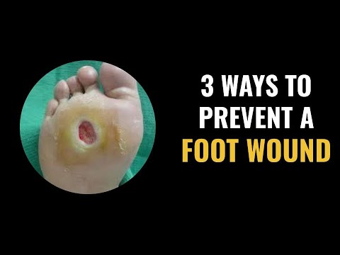 वीडियो: पैर के घाव का इलाज करने के 3 तरीके