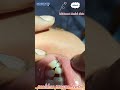Missing tooth last tak