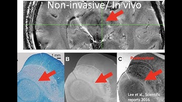 Dual-echo 3D Ultra-short Echo Time MRI with Rosette k-Space Pattern at 7T.