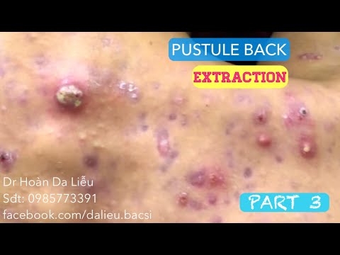 Mụn trứng cá mủ lưng cực nặng|Dermatologist,pimples,whitehead,acne conglobata pustule extraction 3