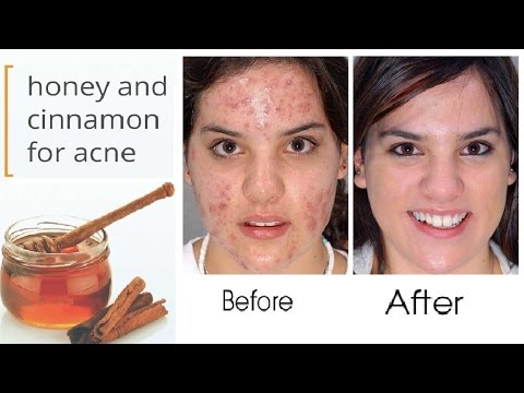 Honey And Cinnamon Mask for Acne | how to remove pimples from face