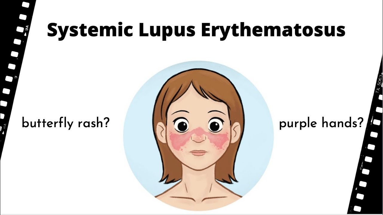 Episode 30 Purple hands and butterfly rash Systemic Lupus Erythematosus (SLE) YouTube