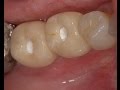 Immediate Implant Placement - Lower Premolar and Molar.