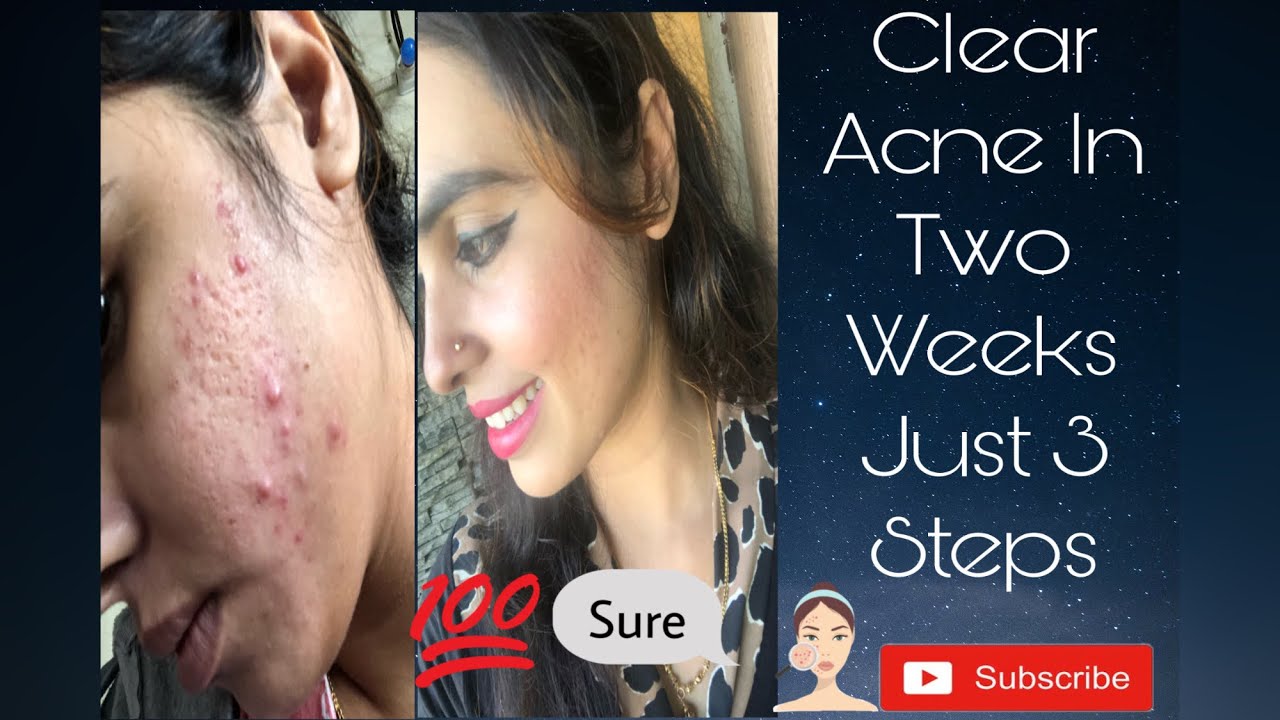 Get Rid Of Acne In Just Two Weeks||Simple Easy Steps|| re equil pitstop Gel Review.