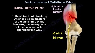 Humerus Fracture with Radial Nerve Palsy and Wrist Drop – Diagnosis and Treatment