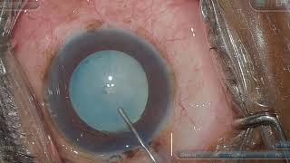 Small Can-opener f/b Normal Rhexis in Intumescent Cataract