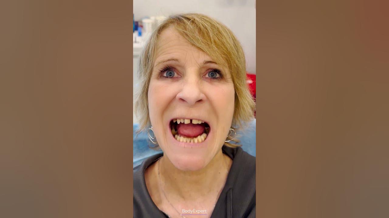 IMPLANTS DENTAIRES EN TURQUIE 🦷 Témoignage de Nadia 3 implants + 24 couronnes Emax