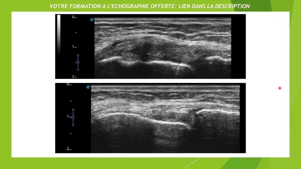 Echographie d'une entorse médiale du genou