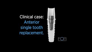 Clinical case: Anterior single tooth replacement using NobelPearl™
