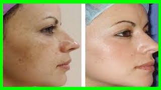 Receita Caseira Para Acabar com Manchas de Melasma, Como Clarear a Pele do Rosto