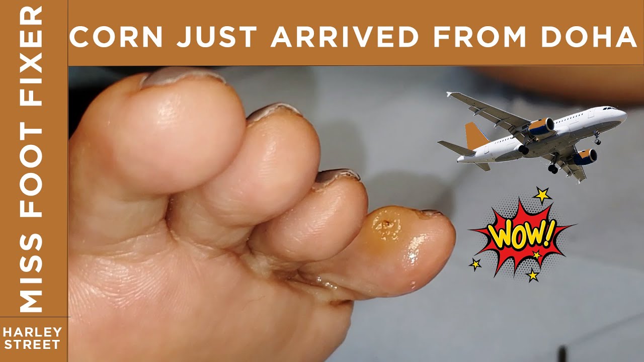 Satisfying corn removal from in between the toesBy Miss Foot Fixer ...