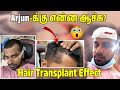 Arjun    6 months  hair transplant   juujee vlogs