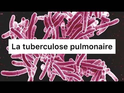 Vidéo: Gravité De La Radiographie Pulmonaire Avant Traitement Et Sa Relation Avec La Charge Bactérienne Dans La Tuberculose Pulmonaire à Frottis Positif