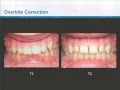 Dr. Clark Colville - Class II Correction with Invisalign and the Carriere Distalizer