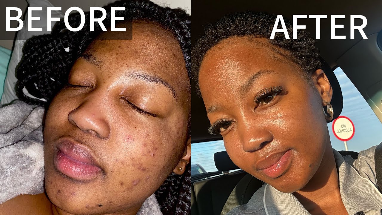 How I cleared my acne and dark spots| Skincare routine added - YouTube