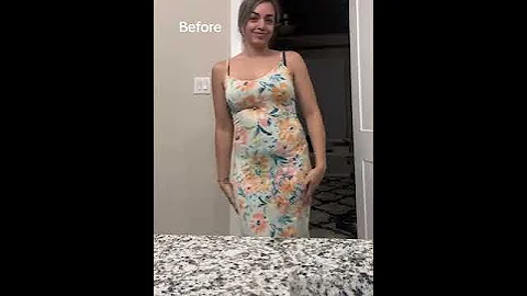 When I Get My Body Done... | Dr. William | BBL Results #miamiplasticsurgery #bbl #drwilliammiami