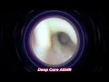 ASMR Ear Cleaning | Guaranteed Tingles and Instant Relaxation