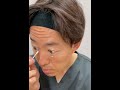 【クマ治療】治療後の内出血、赤みを隠す方法│Theoryクリニック