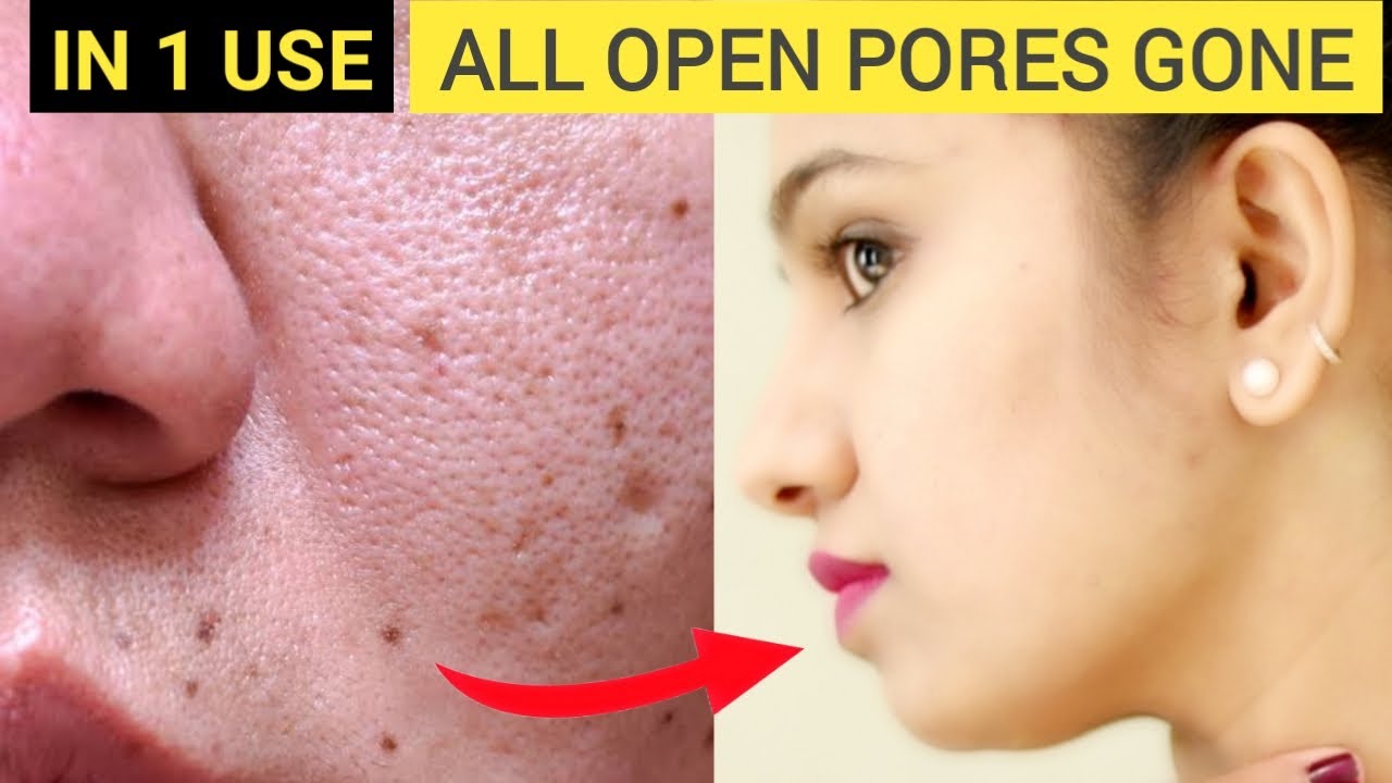 3 Tips -  ಓಪನ್ ಪೋರ್ಸ್ಗೆ ಶಾಶ್ವತ ಪರಿಹಾರ | How To Get Rid Of Large OPEN PORES Permanently At Home