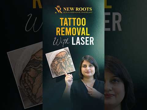 Say Goodbye to Tattoos! Laser Tattoo Removal Cost & Best Results #tattoo #shorts