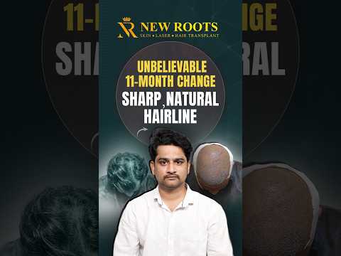 Grade 3 Baldness Hair Transplant Results in Hyderabad #hairtransplant #hyderabad #shorts