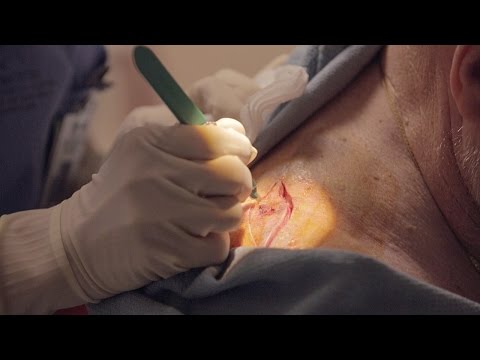 How To Tell If A Mole Is Cancerous - Melanoma Excision
