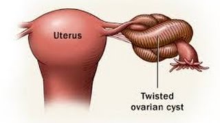 Ovarian Torsion