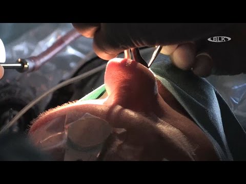 Video: Entfernung Von Uteruspolypen: Operation Mit Oder Ohne Anästhesie, Genesung