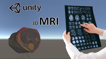 Analyzing MRI Imaging in 3D with Unity and 3D slicer. Plica syndrome
