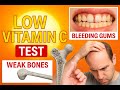 Vitamin C Deficiency? | Blood Test & Symptoms You Shouldn't Ignore #vitaminc