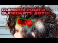 🔴 Que es ALOPECIA AREATA? + CURSO DE MESOTERAPIA CAPILAR 🏆🔥