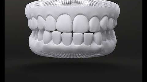 NIỀNG RĂNG KHỚP CẮN NGƯỢC