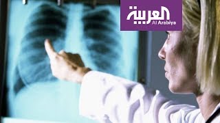 صباح العربية: السيجارة الالكترونية لا تسبب تجمع الماء في الرئة