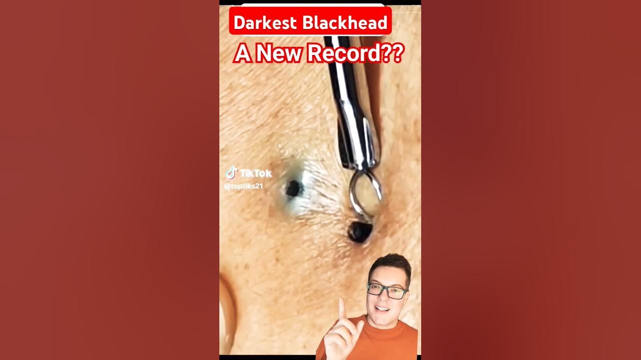 Darkest Ever BLACKHEAD REMOVAL Shocking shorts YouTube