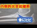 大型犬の内側鉤状突起離断