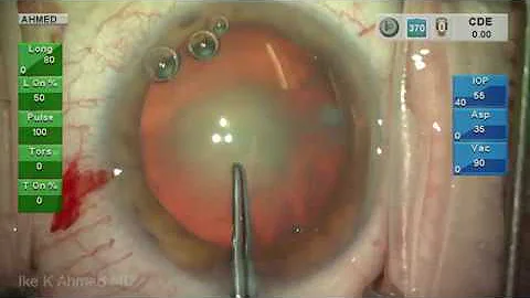 Routine Cataract Surgery Narrated Ike Ahmed