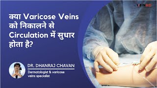Does Removing Varicose Veins Improve Circulation? | VeinMD, Pune