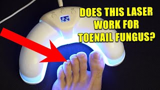 Download Lagu Neoclear Laser voor schimmelnagels review - Ik heb een antischimmelapparaat geprobeerd om te zien... MP3 Download Lagu Neoclear Laser voor schimmelnagels review - Ik heb een antischimmelapparaat geprobeerd om te zien... MP3