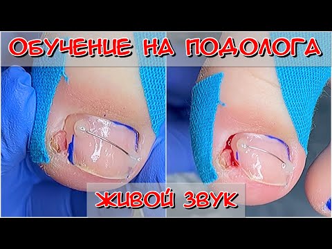 Атмосфера живого курса / Обучение по подологии / Как выстригать вросший ноготь / #подология #Ногти