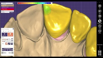 Certified Exocad Designer: Mastering Mirror Tool for Perfect Central, Lateral & Canine Restorations